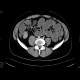 ileus, small bowel obstruction on terminal ileum: CT - Computed tomography